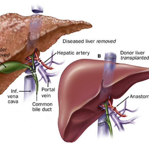Liver transplant