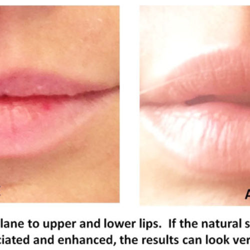 Lip-Augmentation
