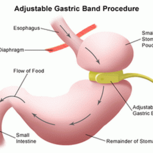 Bariartic-Procedures