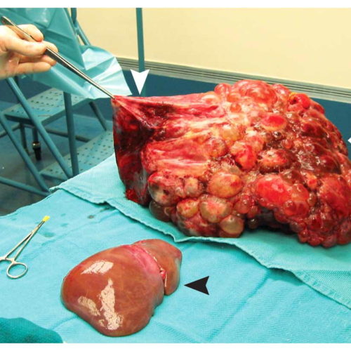 Liver transplant